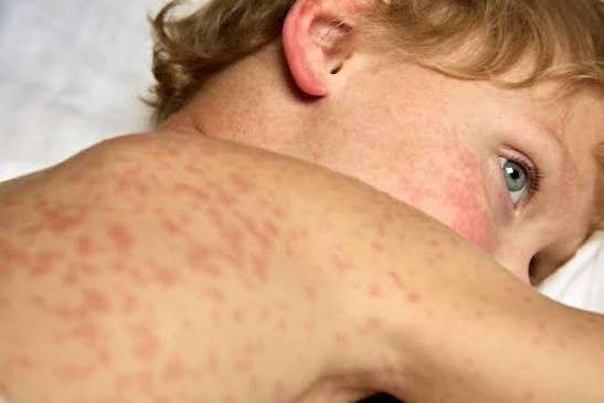 measles 2